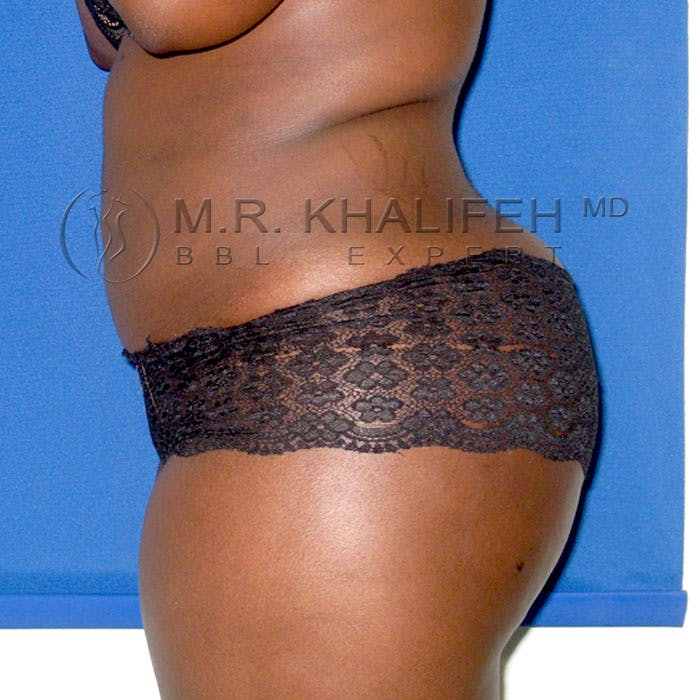Flank-Lower Back Liposuction Gallery - Patient 3720334 - Image 6