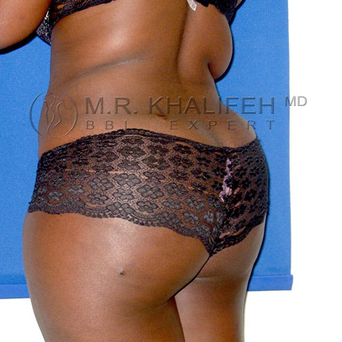 Flank-Lower Back Liposuction Gallery - Patient 3720334 - Image 8