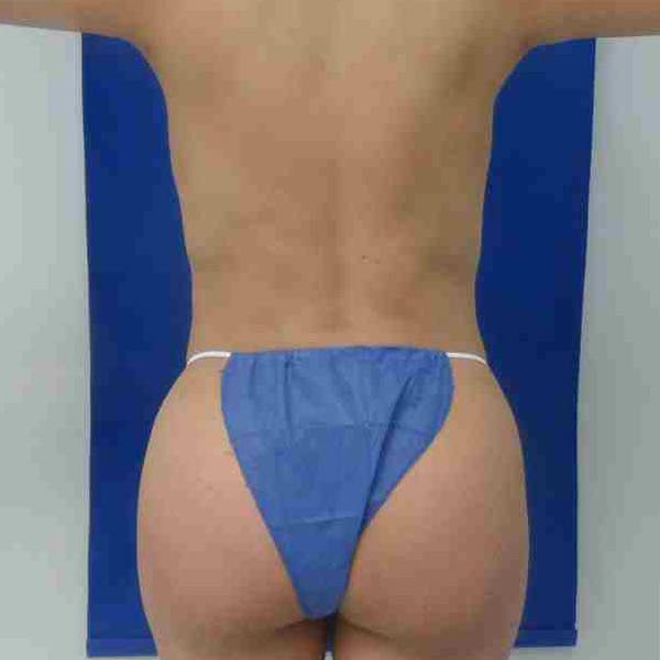 Flank-Lower Back Liposuction Gallery - Patient 3720376 - Image 4