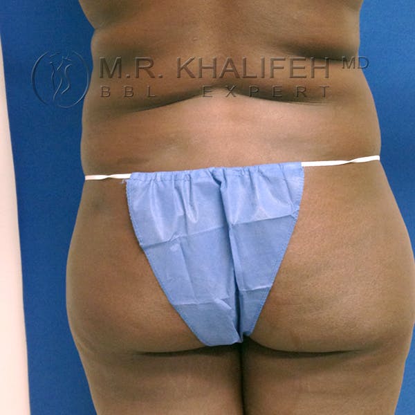 Flank-Lower Back Liposuction Gallery - Patient 3720700 - Image 1