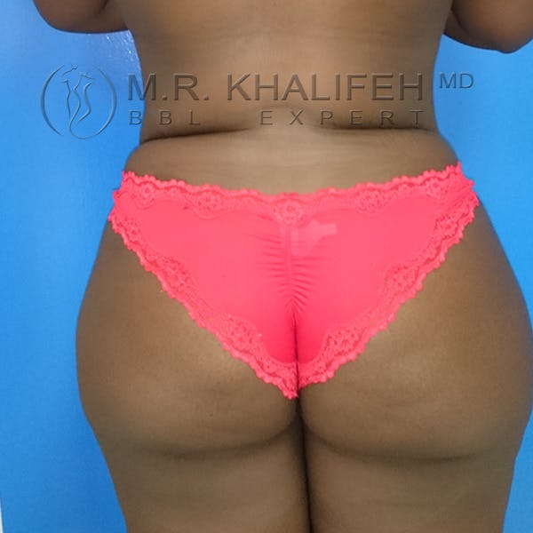 Flank-Lower Back Liposuction Gallery - Patient 3720700 - Image 2