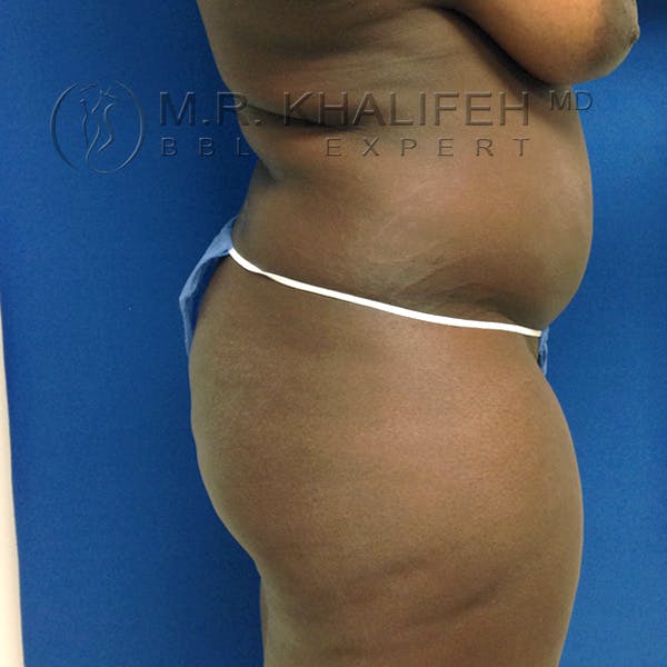 Flank-Lower Back Liposuction Gallery - Patient 3720700 - Image 3