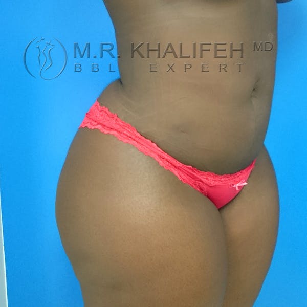 Flank-Lower Back Liposuction Gallery - Patient 3720700 - Image 6