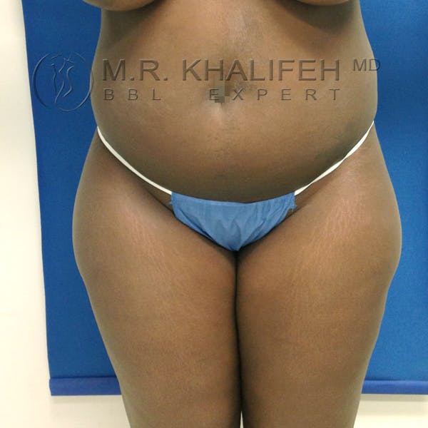 Flank-Lower Back Liposuction Gallery - Patient 3720700 - Image 7