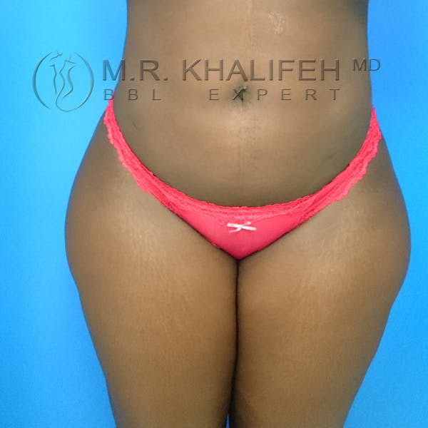 Flank-Lower Back Liposuction Gallery - Patient 3720700 - Image 8