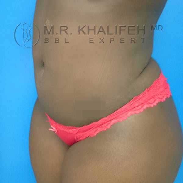Flank-Lower Back Liposuction Gallery - Patient 3720700 - Image 10