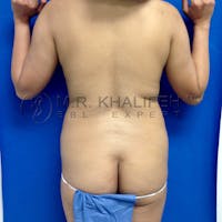 Flank-Lower Back Liposuction Gallery - Patient 3720768 - Image 1