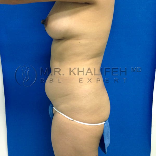 Flank-Lower Back Liposuction Gallery - Patient 3720768 - Image 5