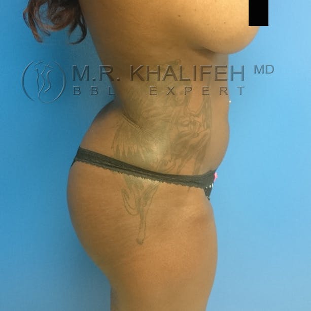 Flank-Lower Back Liposuction Gallery - Patient 3720834 - Image 4