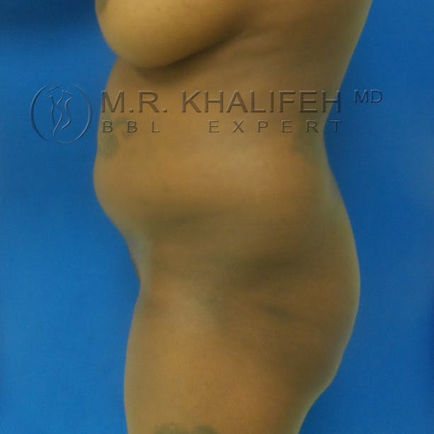 Flank-Lower Back Liposuction Gallery - Patient 3720834 - Image 5