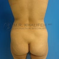 Flank-Lower Back Liposuction Gallery - Patient 3720888 - Image 1