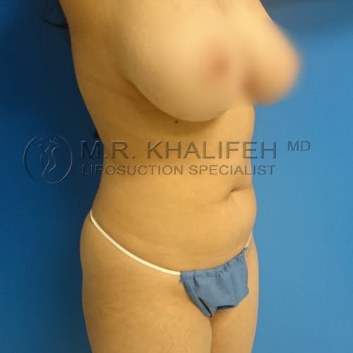 Flank-Lower Back Liposuction Gallery - Patient 3720888 - Image 5