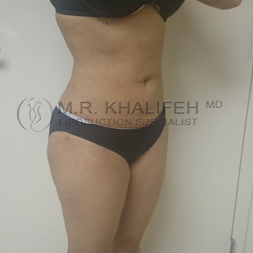 Flank-Lower Back Liposuction Gallery - Patient 3720888 - Image 6