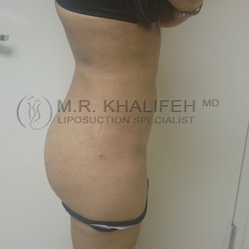 Flank-Lower Back Liposuction Gallery - Patient 3720888 - Image 8