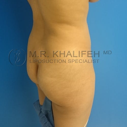 Flank-Lower Back Liposuction Gallery - Patient 3720888 - Image 9