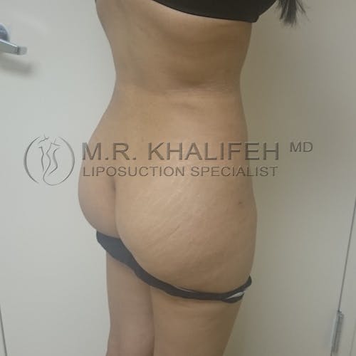 Flank-Lower Back Liposuction Gallery - Patient 3720888 - Image 10