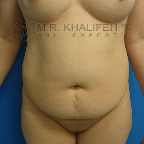 Flank-Lower Back Liposuction Gallery - Patient 3720949 - Image 3