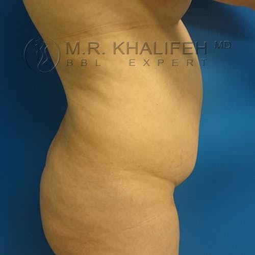 Flank-Lower Back Liposuction Gallery - Patient 3720949 - Image 5
