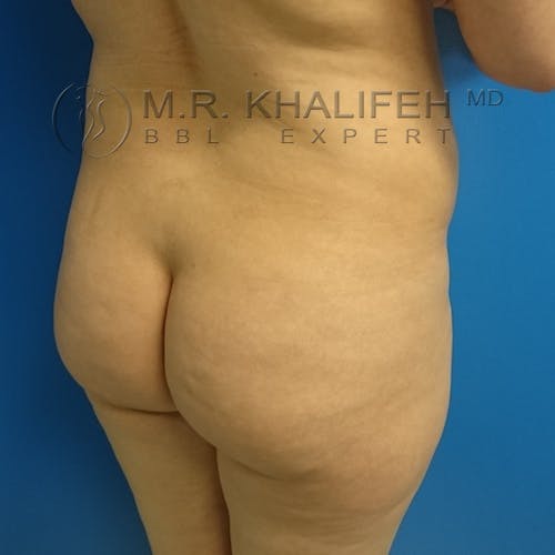 Flank-Lower Back Liposuction Gallery - Patient 3720949 - Image 7