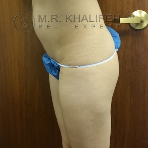 Flank-Lower Back Liposuction Gallery - Patient 3721014 - Image 3