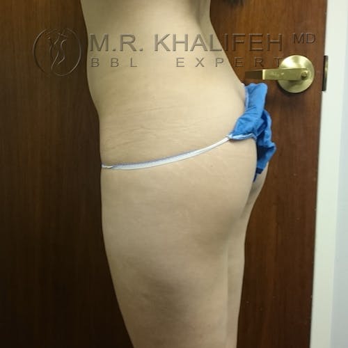 Flank-Lower Back Liposuction Gallery - Patient 3721014 - Image 5