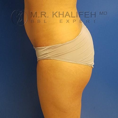 Flank-Lower Back Liposuction Gallery - Patient 3721014 - Image 6
