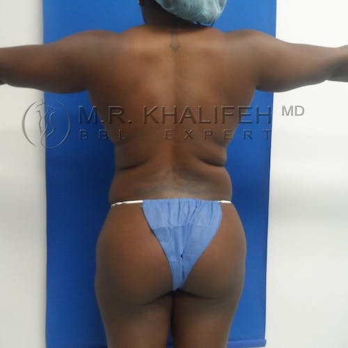Flank-Lower Back Liposuction Gallery - Patient 3721097 - Image 1