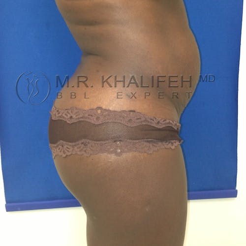 Flank-Lower Back Liposuction Gallery - Patient 3721097 - Image 5