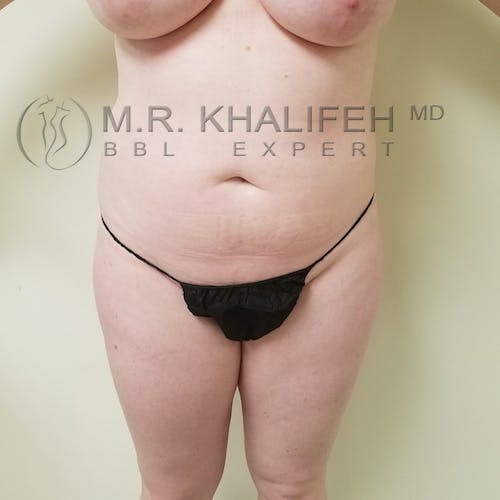 Flank-Lower Back Liposuction Gallery - Patient 3721256 - Image 3