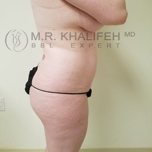 Flank-Lower Back Liposuction Gallery - Patient 3721256 - Image 7