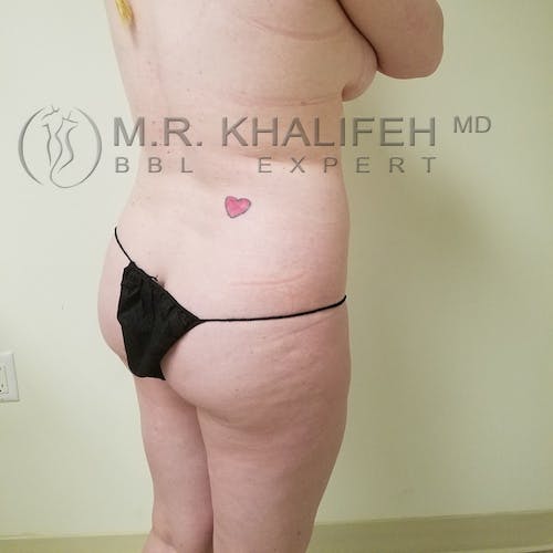 Flank-Lower Back Liposuction Gallery - Patient 3721256 - Image 9