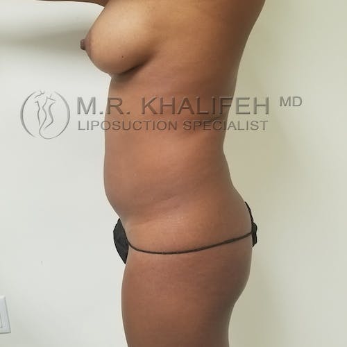 Flank-Lower Back Liposuction Gallery - Patient 3721290 - Image 3