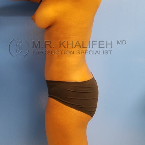 Flank-Lower Back Liposuction Gallery - Patient 3721290 - Image 4