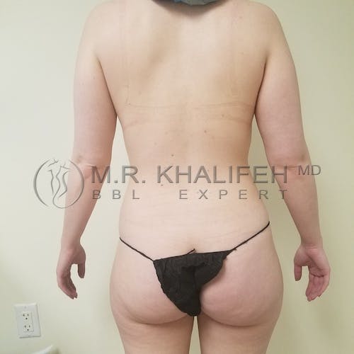 Flank-Lower Back Liposuction Gallery - Patient 3721361 - Image 1