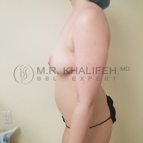 Flank-Lower Back Liposuction Gallery - Patient 3721361 - Image 5