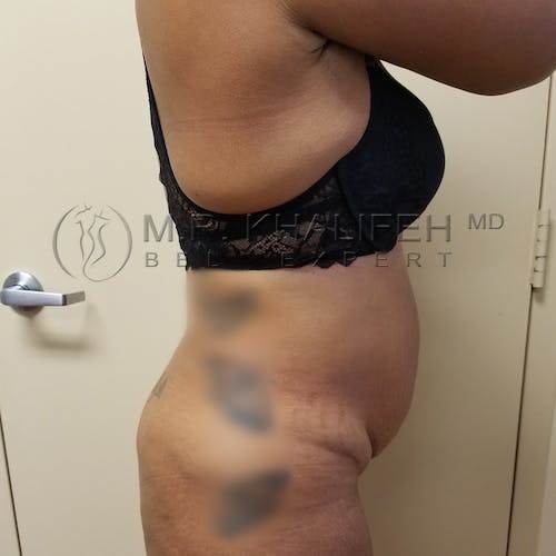 Flank-Lower Back Liposuction Gallery - Patient 3721402 - Image 3