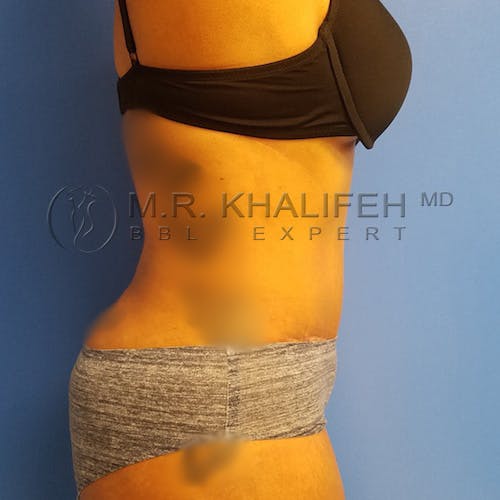 Flank-Lower Back Liposuction Gallery - Patient 3721402 - Image 4