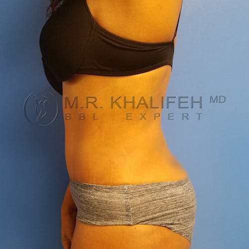Flank-Lower Back Liposuction Gallery - Patient 3721402 - Image 6