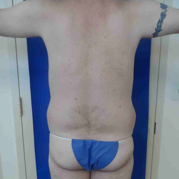 Flank-Lower Back Liposuction Gallery - Patient 3721490 - Image 1