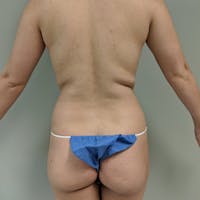 Flank-Lower Back Liposuction Gallery - Patient 3721883 - Image 1