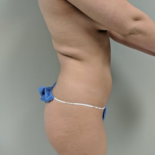 Flank-Lower Back Liposuction Gallery - Patient 3721883 - Image 7