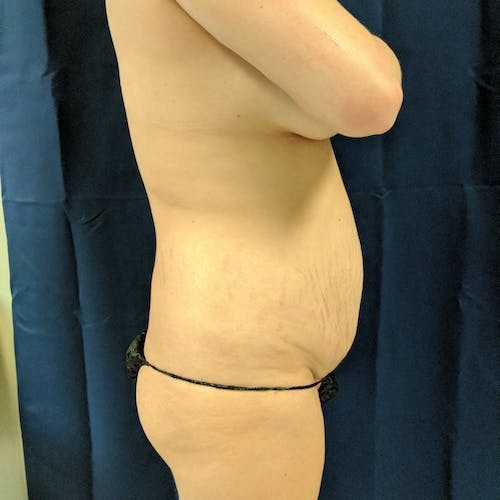 Flank-Lower Back Liposuction Gallery - Patient 3721923 - Image 3