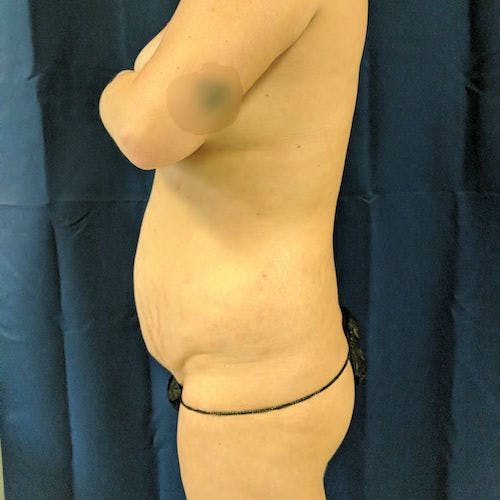 Flank-Lower Back Liposuction Gallery - Patient 3721923 - Image 5