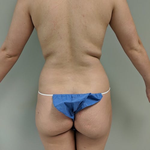 Flank-Lower Back Liposuction Gallery - Patient 3722000 - Image 1