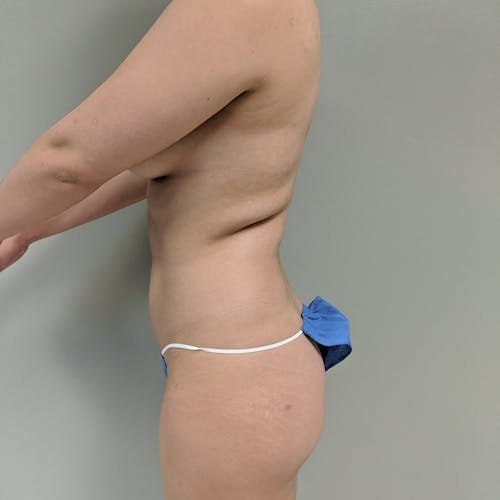 Flank-Lower Back Liposuction Gallery - Patient 3722000 - Image 3