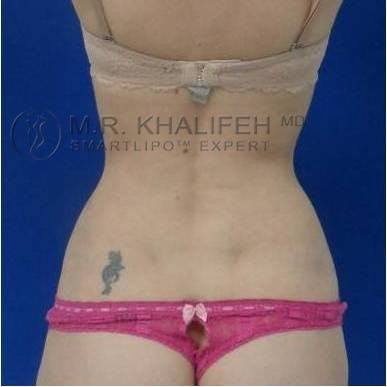 Abdominal Liposuction Gallery - Patient 92865300 - Image 8