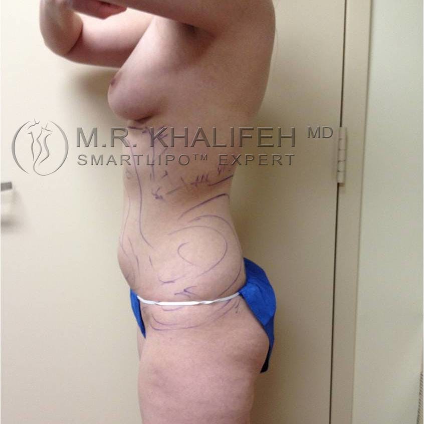 Abdominal Liposuction Gallery - Patient 92865300 - Image 3