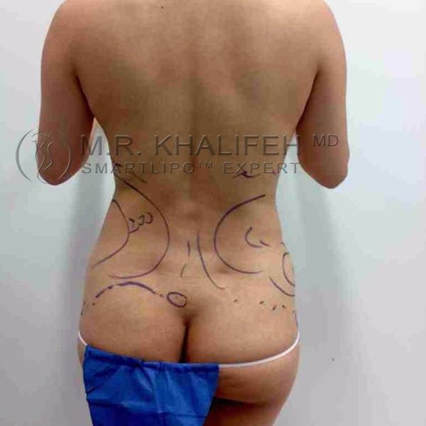 Abdominal Liposuction Gallery - Patient 92865303 - Image 7