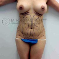 Abdominal Liposuction Gallery - Patient 92865303 - Image 1
