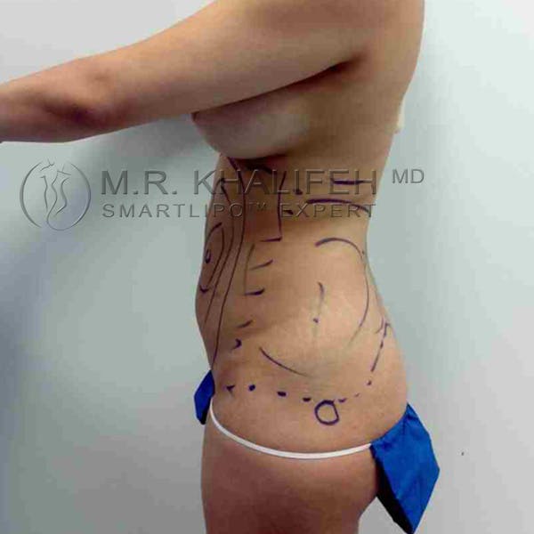 Abdominal Liposuction Gallery - Patient 92865303 - Image 3